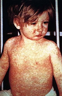 measles wiki